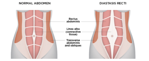 Active Physio Works Diastasis Rectus Abdominis Abdominal Separation